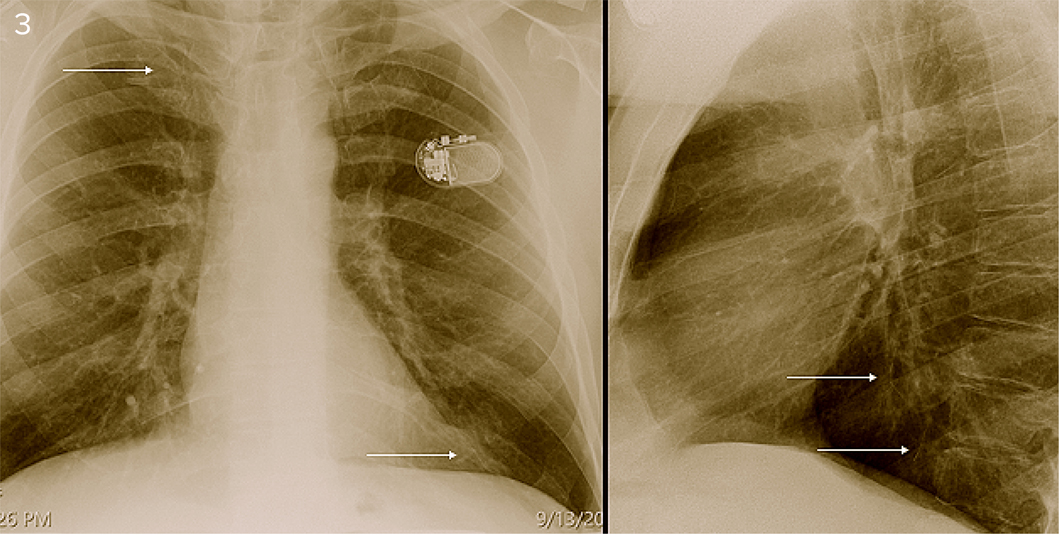 Fragments from IVC filter struts within the pulmonary veins